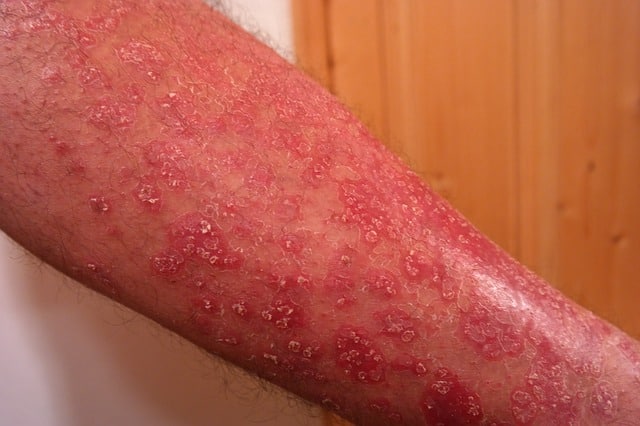 Haut Erkrankungen Hautkrankheiten 2