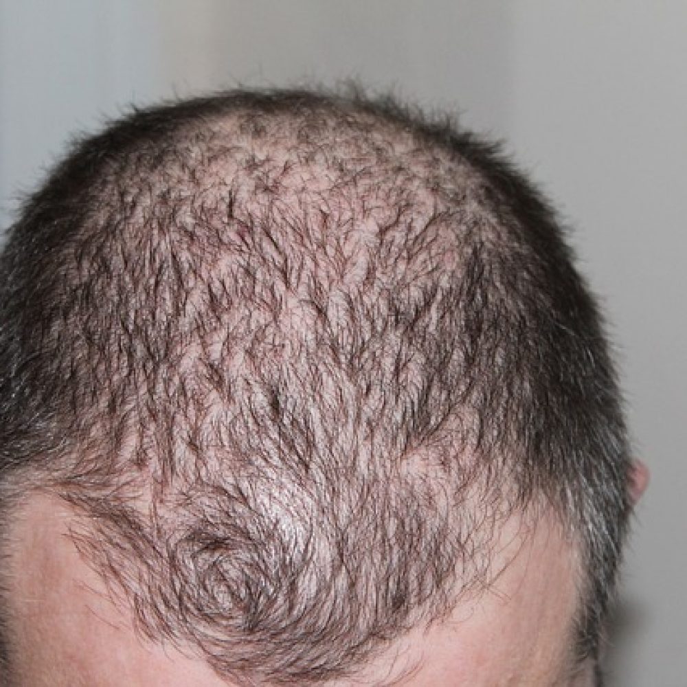 Alopezie