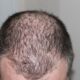 Alopezie Alopezie 2