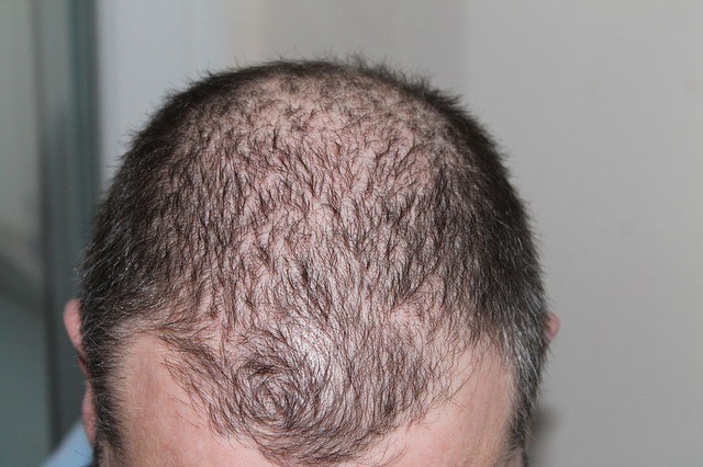 Alopezie Alopezie 3