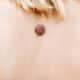 Wart. Mole. big wart on the skin. Skin diseases Malignant tumor. Dermatology. Oncology.
